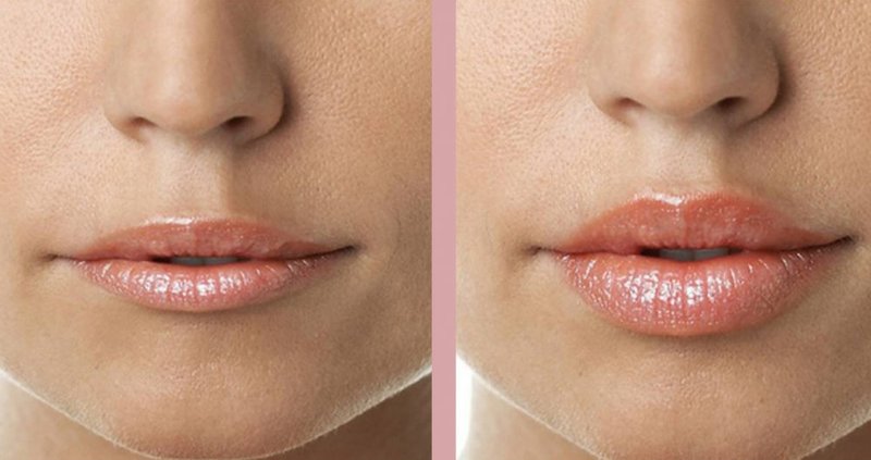Lèvres avant et après le contour des lèvres à l'acide hyaluronique