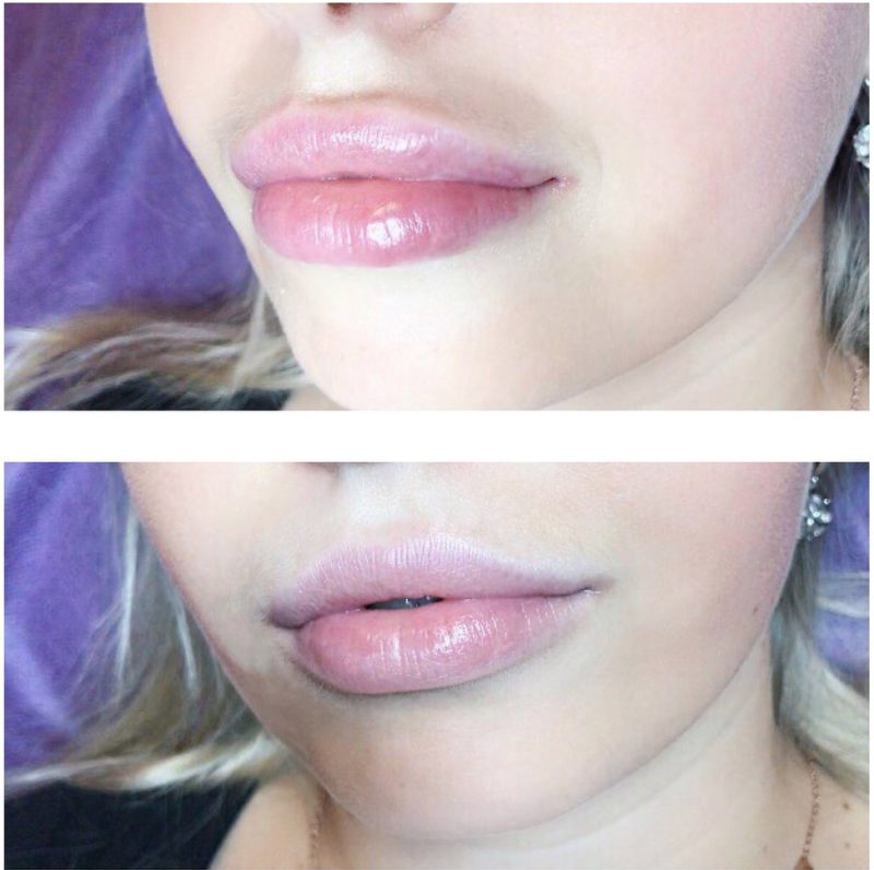 Gonflement des lèvres après l'élargissement de l'acide hyaluronique