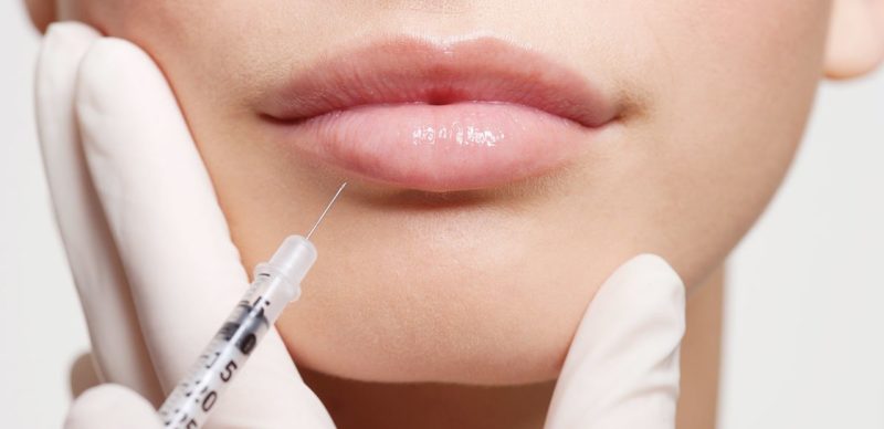 Injection d'acide hyaluronique dans les lèvres