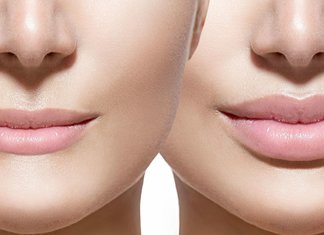 Augmentation des lèvres: que se passera-t-il après la procédure?
