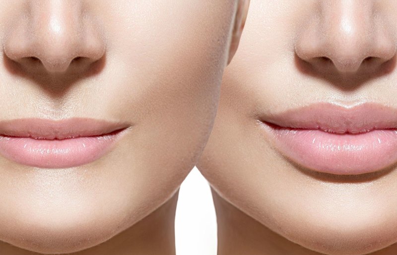 Lèvres avant et après l'élargissement de l'acide hyaluronique