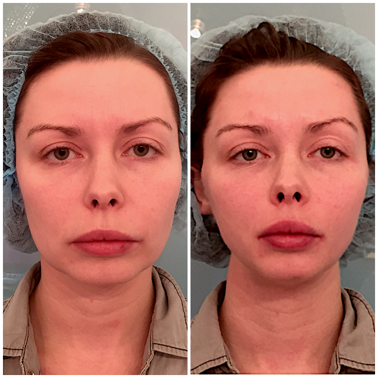 Tråd ansiktsløftning: før og etter bilder