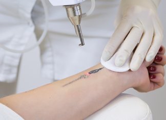 Eliminarea tatuajului cu laser
