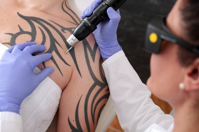 Laser tattoo verwijdering